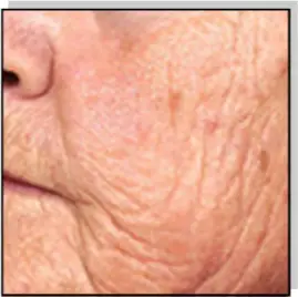 Avance Beauty IPL Resurfacing and Photo-Rejuvenation 1