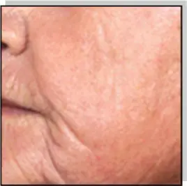 Avance Beauty IPL Resurfacing and Photo-Rejuvenation 2