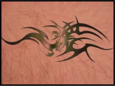 Avance Beauty IPL Tattoo Removal 1