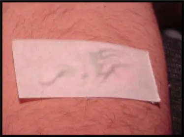 Avance Beauty IPL Tattoo Removal 2