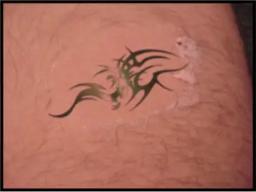 Avance Beauty IPL Tattoo Removal 3