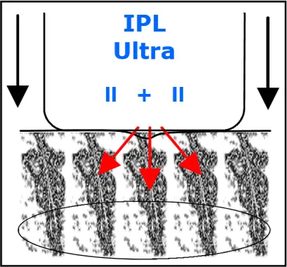 Avance Beauty - IPL Ultra