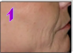 Avance Beauty IPL350-HR - Treatment Procedure 1