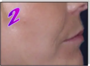 Avance Beauty IPL350-HR - Treatment Procedure 2