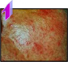 Avance Beauty IPL350-HR - Treatment Procedure 3