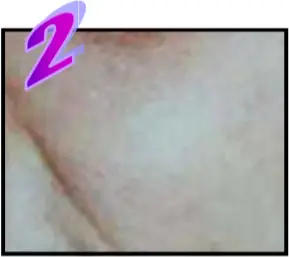 Avance Beauty IPL350-HR - Treatment Procedure 4