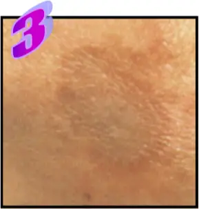 Avance Beauty IPL350-HR - Treatment Procedure 5