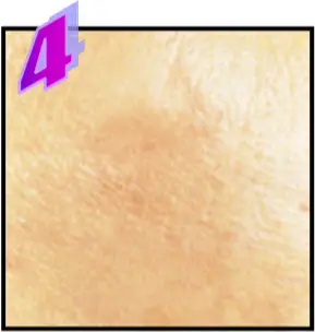 Avance Beauty IPL350-HR - Treatment Procedure 6