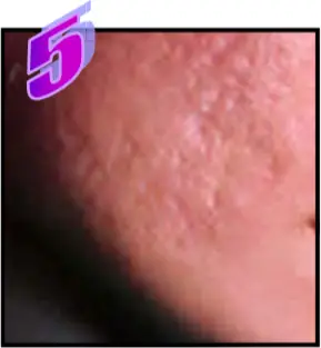 Avance Beauty IPL350-HR - Treatment Procedure 7