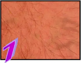 Avance Beauty - The Treatment Procedure 1