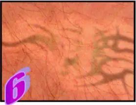 Avance Beauty - The Treatment Procedure 6