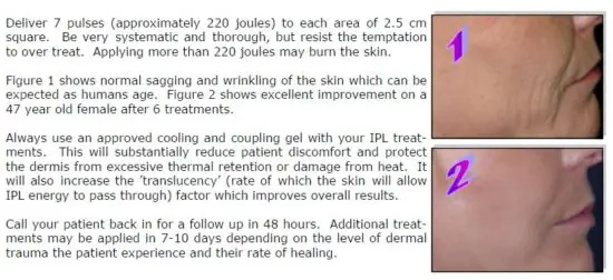 FIG 12 Treatment Procedure Resurfacing and Wrinkle Reduction.JPG