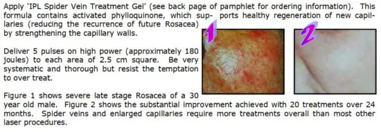 FIG 13 Treatment Procedure Rosacea.JPG