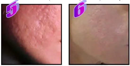 FIG 15 Treatment Procedure Scars.JPG