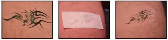 FIG 18 IPL Tattoo Removal.JPG