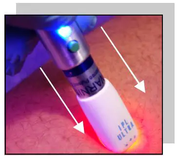 FIG 21 Intense Pulsed Light Progressively Permanent Hair Removal.JPG