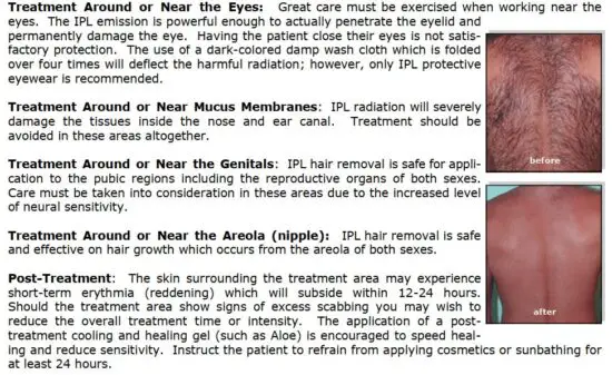 FIG 25 Important Considerations for Safe IPL Hair Removal Treatment.JPG