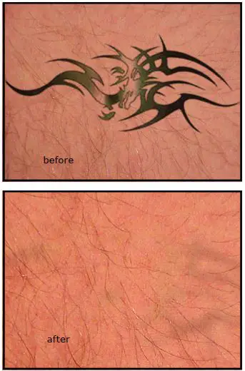 FIG 27 Important Considerations for Safe IPL Tattoo Treatment.JPG